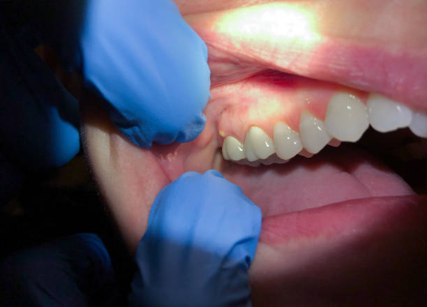 Best Emergency Wisdom Tooth Extraction in Dodgeville, WI